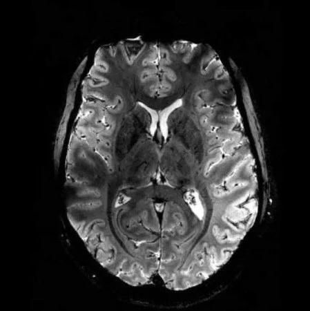 Impacto da Precisão do Registro em Lesões de EM